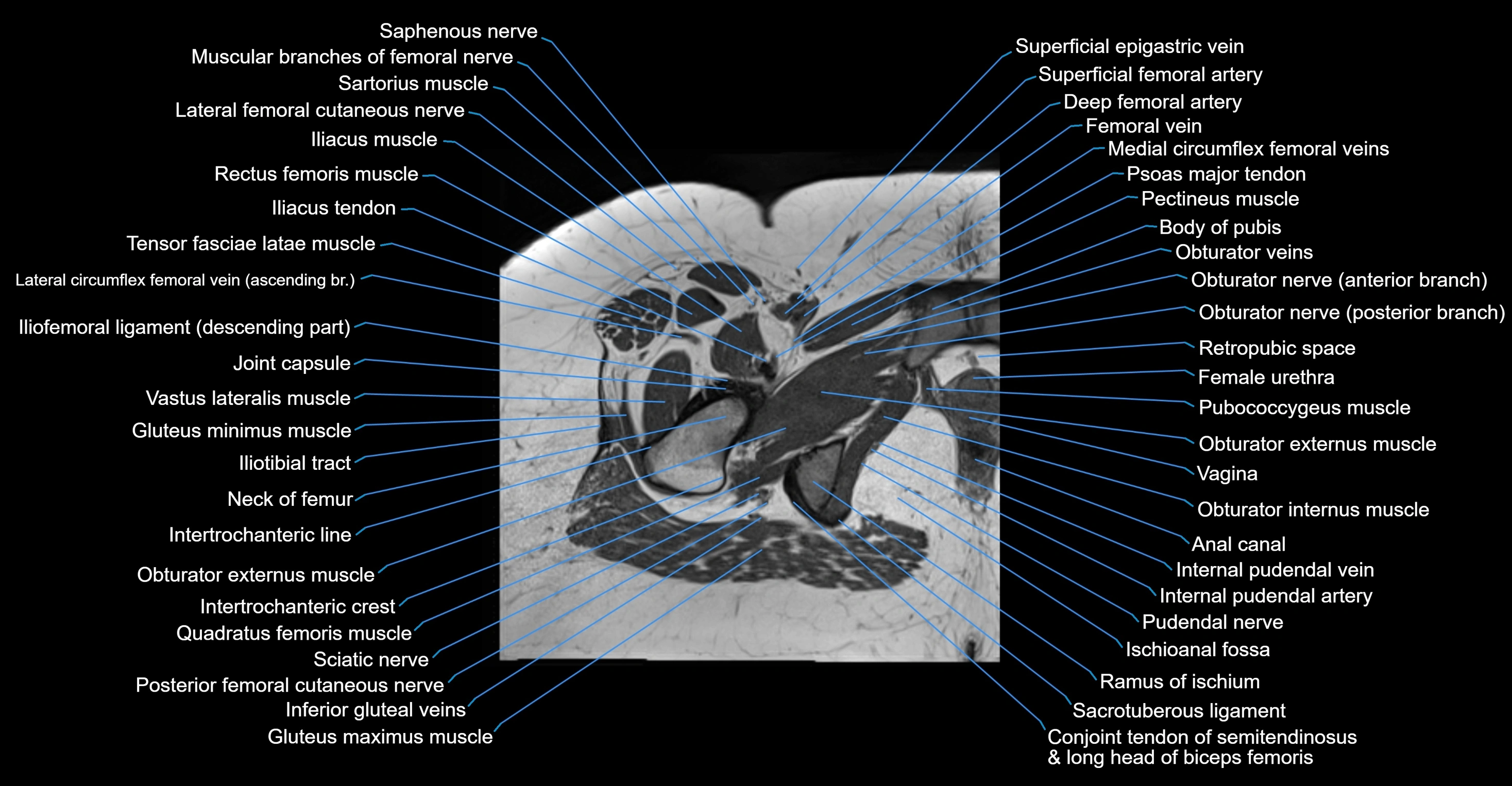MRI hip axial cross sectional anatomy 3T 3D  radiology  anatomy image-img-00001-00053.webp